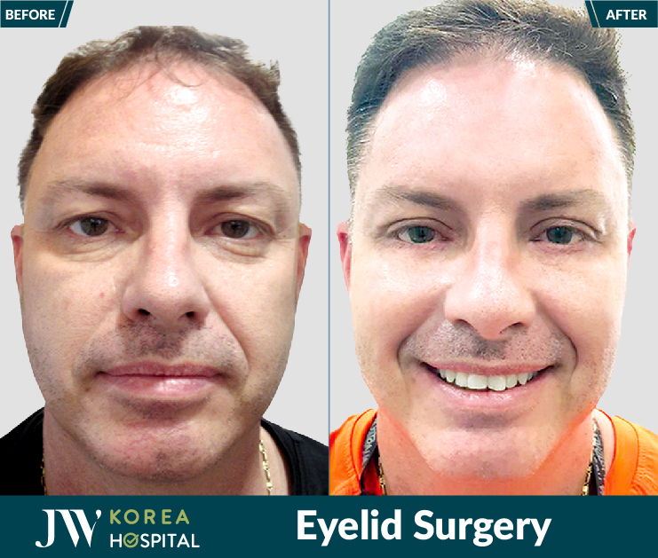 eyelid surgery result at JW