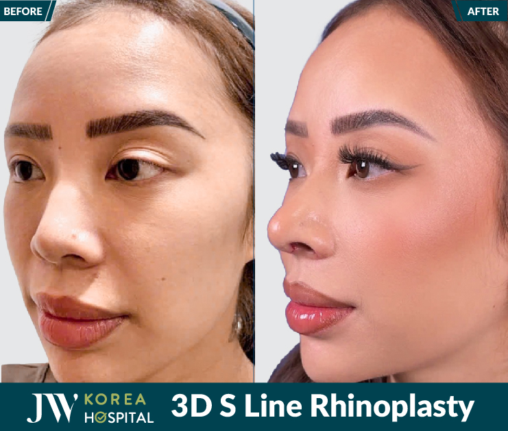 3D S Line Rhynoplasty result
