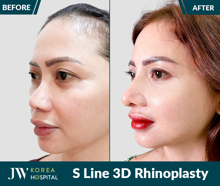 Rhinoplasty at JW Hospital – Achieve a high, elegant, and naturally nose