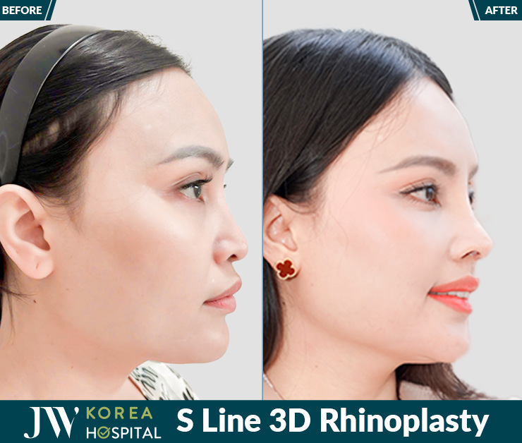 3 days swelling down, 7 days to a refined high nose at JW Hospital