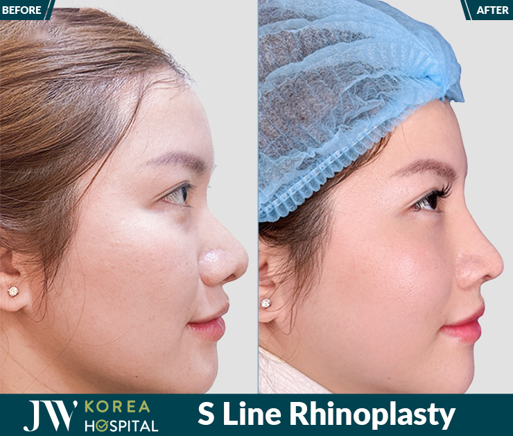 Clients fully satisfied with their natural high nose at JW Hospital