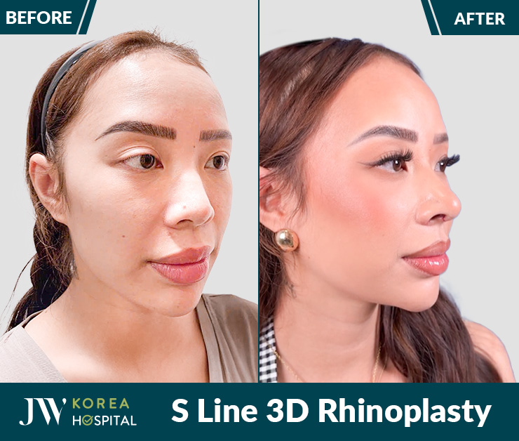 Clients are highly satisfied with their rhinoplasty results at JW Hospital