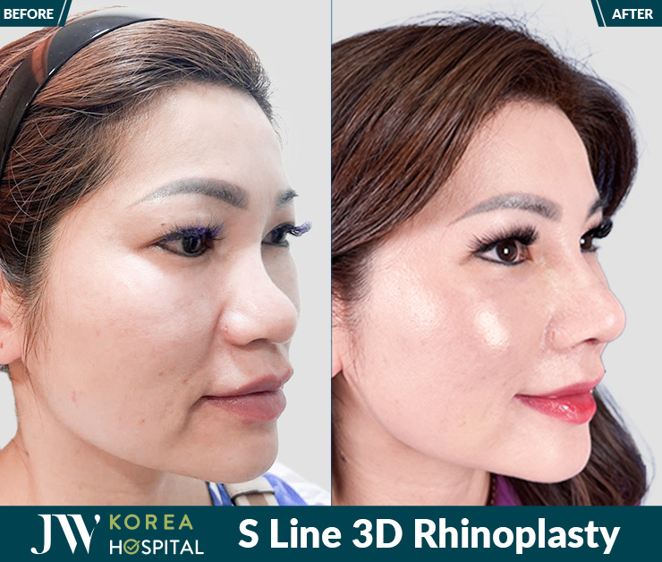 Rhinoplasty at JW Hospital enhances facial harmony with a refined, balanced, and naturally beautiful nose.