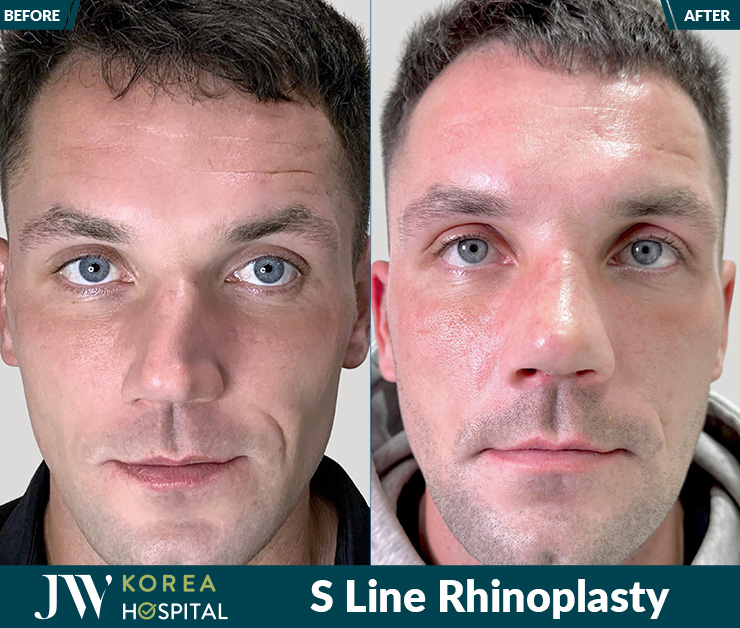 Rhinoplasty at JW Hospital brings a graceful nose shape that elevates overall appearance with natural charm.