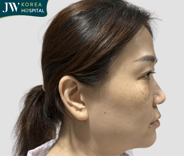 Correct flat nose and bulky tip with rhinoplasty at JW Hospital