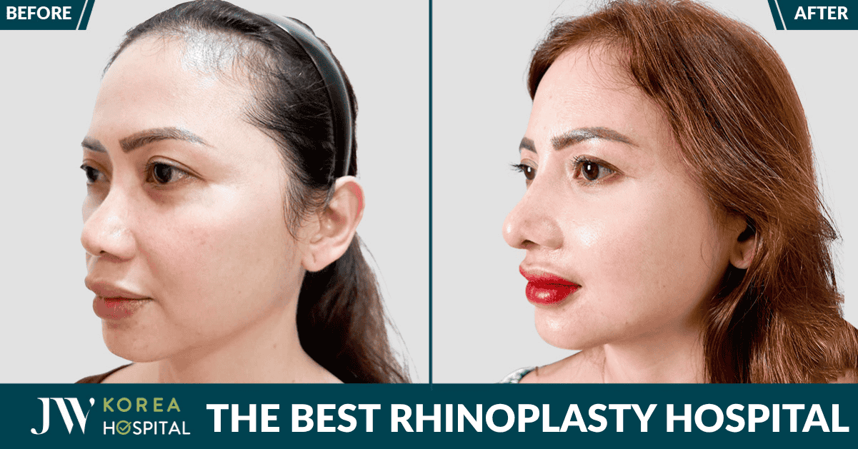 Best Rhinoplasty Clinics in Vietnam: Top Hospitals for Natural Results & Safe Surgery