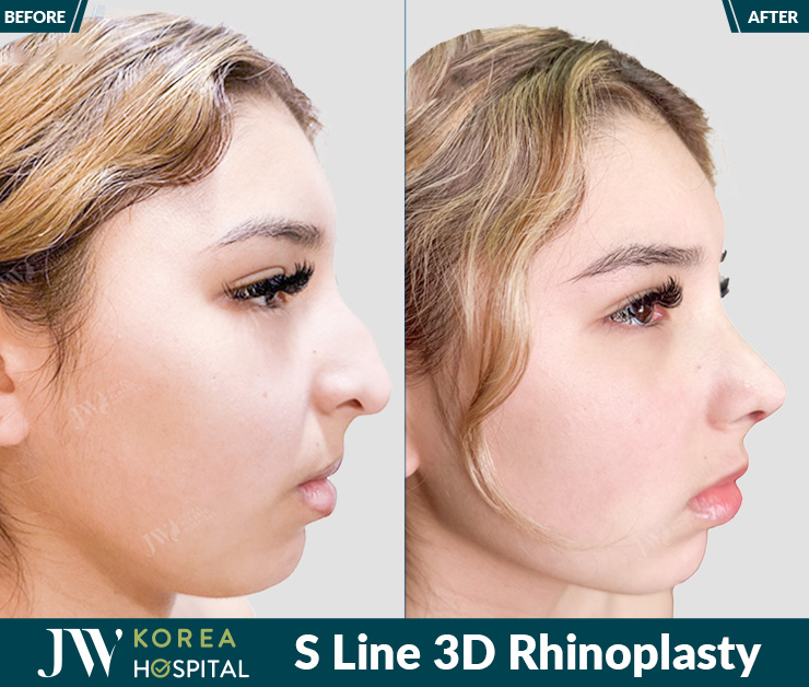 Rhinoplasty at JW Hospital helps achieve a high, elegant, attractive, and natural-looking nose.