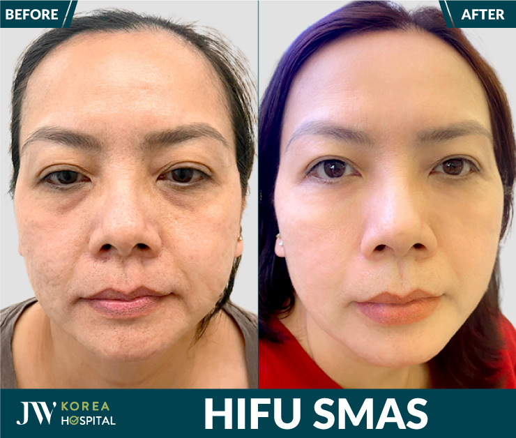 HIFU technology helps tighten the skin and effectively reduce sagging