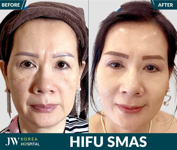 Naturally lifted and firm facial skin thanks to HIFU treatment