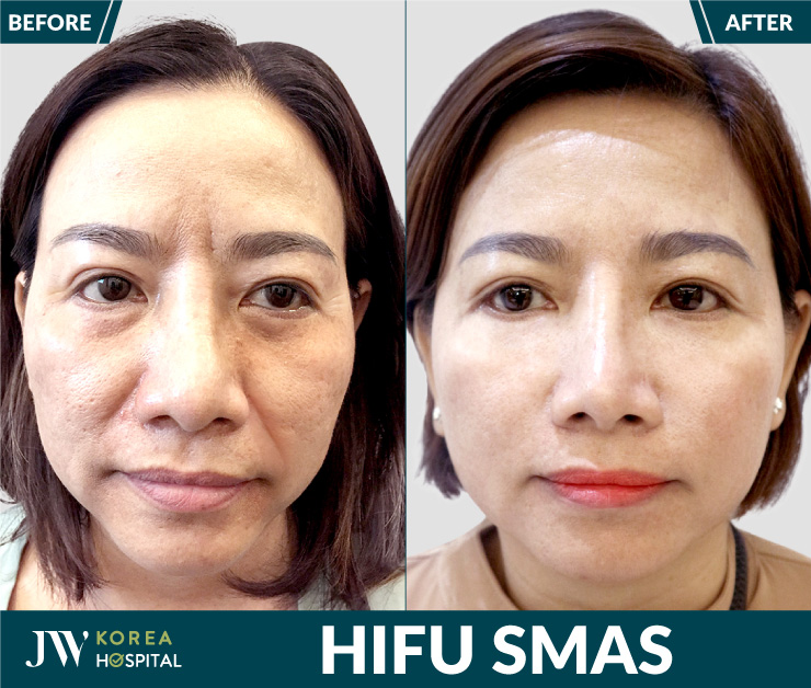 Before and after HIFU: firmer skin with visibly reduced wrinkles