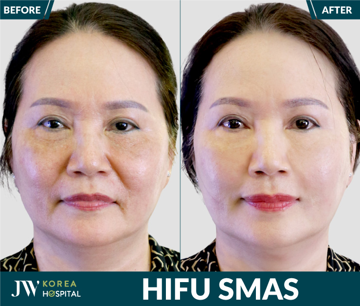 Non-invasive HIFU treatment, no downtime required