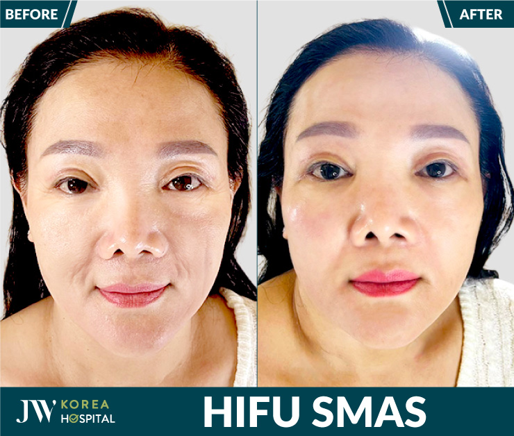 Before-and-after results of HIFU facial rejuvenation treatment